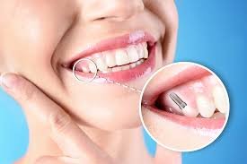 Dental Implant Procedure